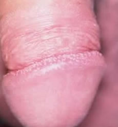 Hirsuties papillaris penis